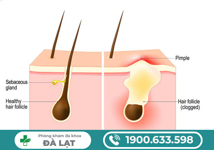 Hình ảnh minh họa